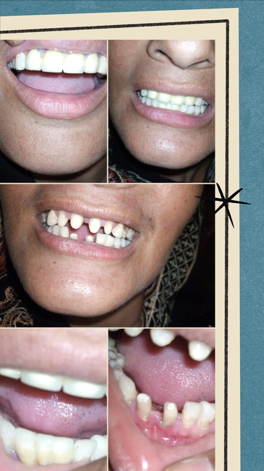 Full Mouth Restoration before
