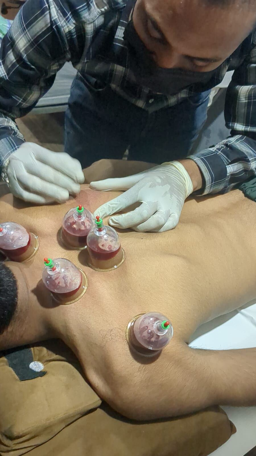 Hijama Therapy